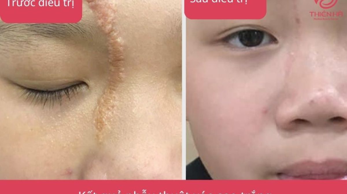 Xóa sẹo trắng hiệu quả: Phương pháp, chi phí và lưu ý quan trọng