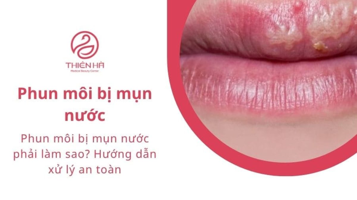 Phun môi bị mụn nước phải làm sao? Hướng dẫn xử lý an toàn