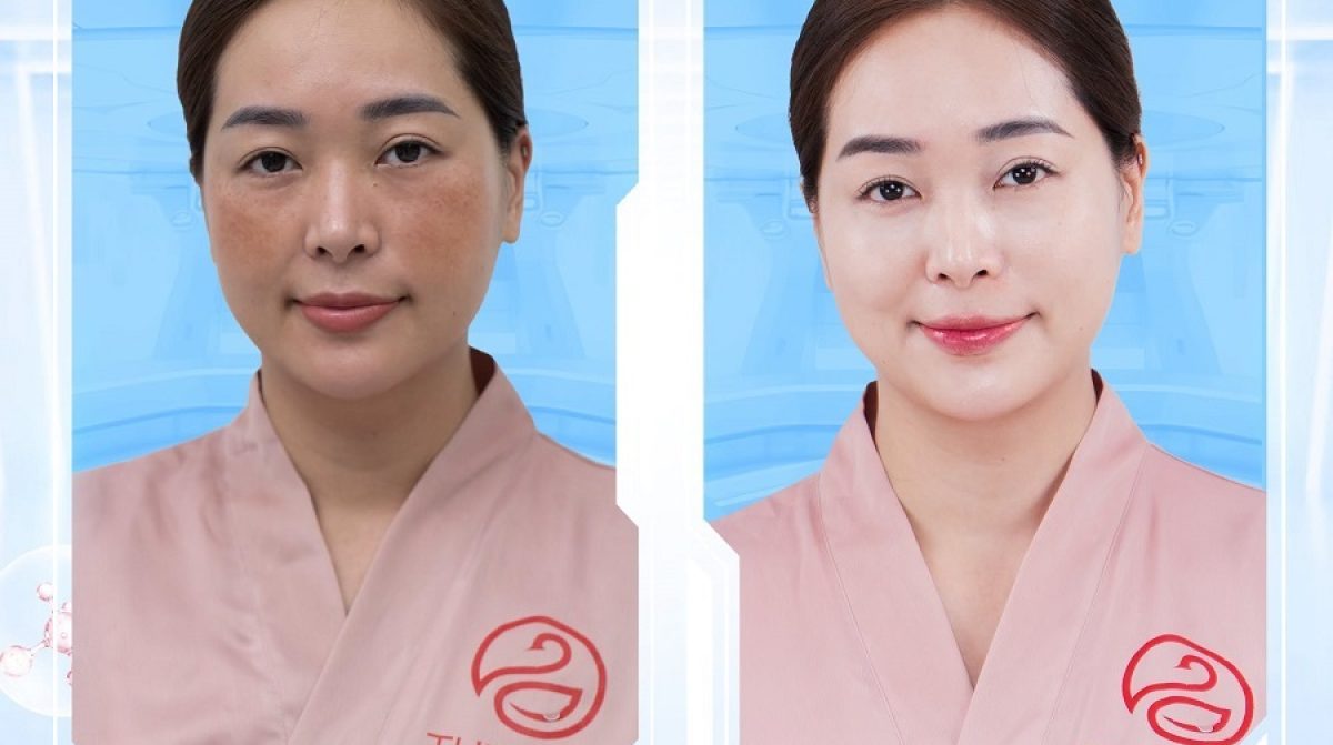 Review trị nám bằng laser: Kết quả trước sau và chi phí thực tế