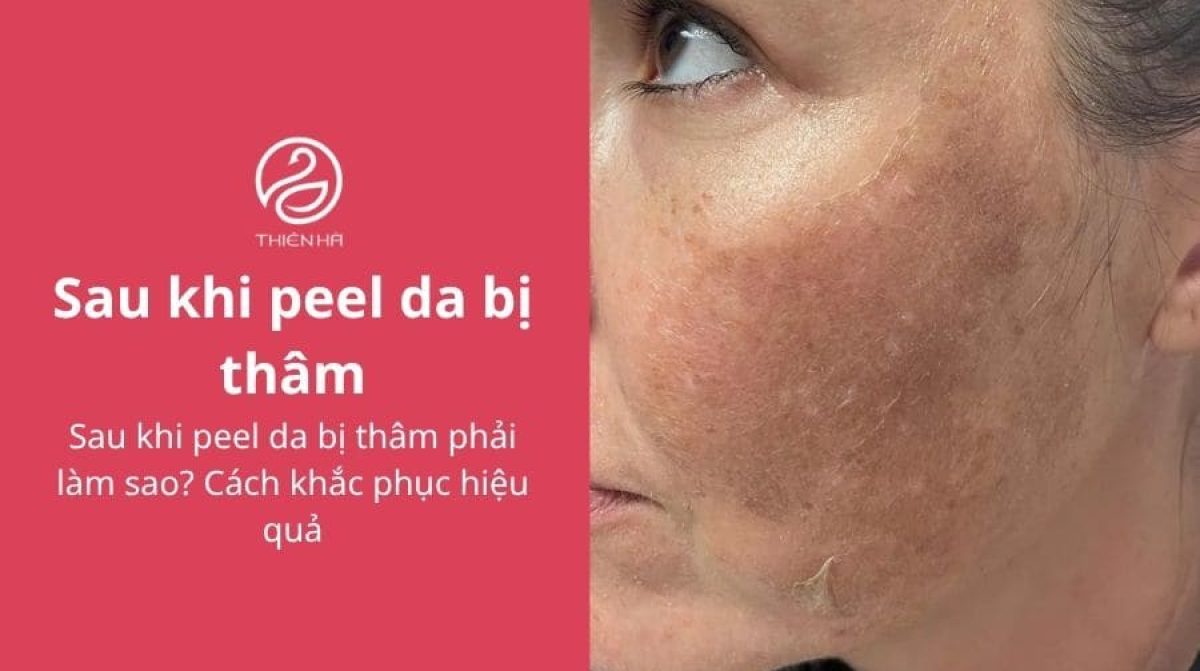 Sau khi peel da bị thâm phải làm sao? Cách khắc phục hiệu quả