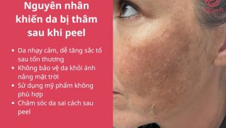 Sau khi peel da bị thâm: Lý do và cách điều trị tốt nhất
