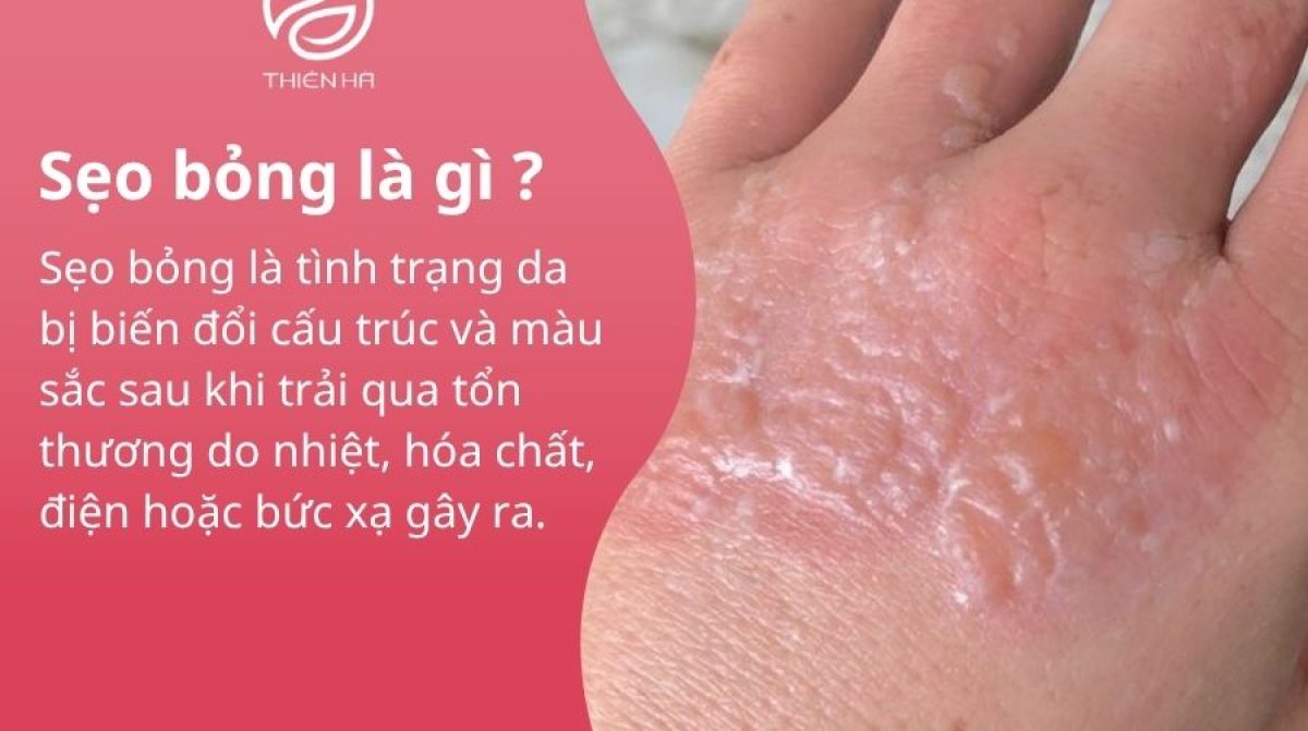 Điều trị sẹo bỏng hiệu quả: từ sơ cứu ban đầu đến công nghệ y khoa