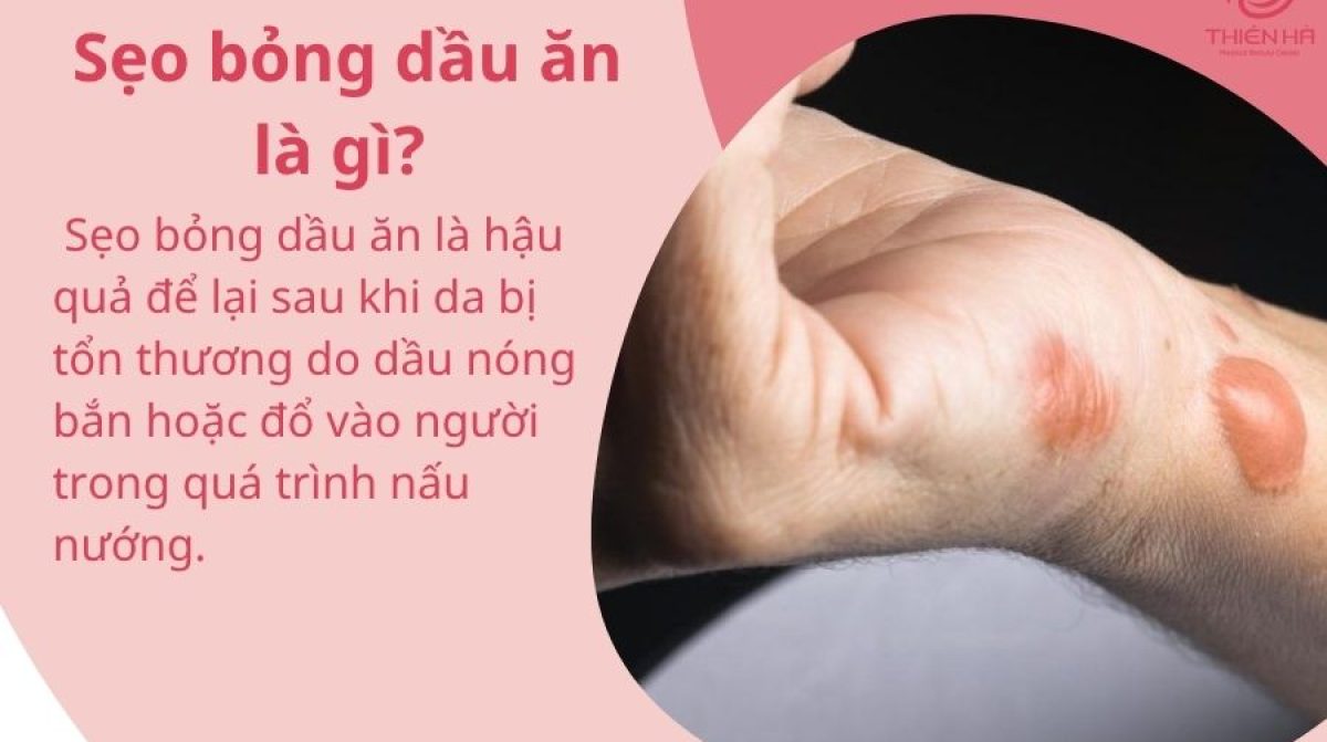 Sẹo bỏng dầu ăn: Giải pháp khắc phục từ dân gian đến công nghệ cao