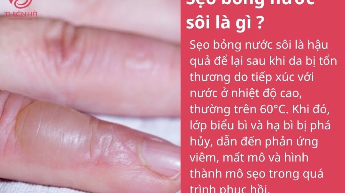 Cách xóa sẹo bỏng nước sôi an toàn, được Viện Thẩm Mỹ Thiên Hà tư vấn