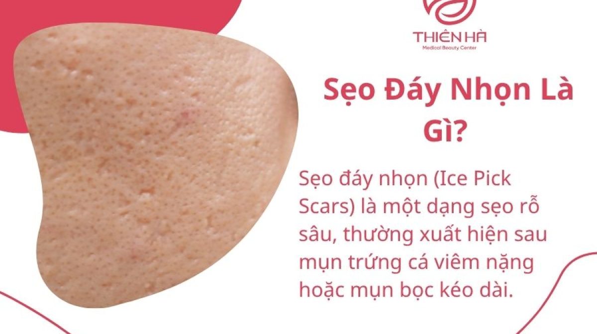 Sẹo Đáy Nhọn Là Gì? Nguyên Nhân Và Cách Trị Sẹo Hiệu Quả
