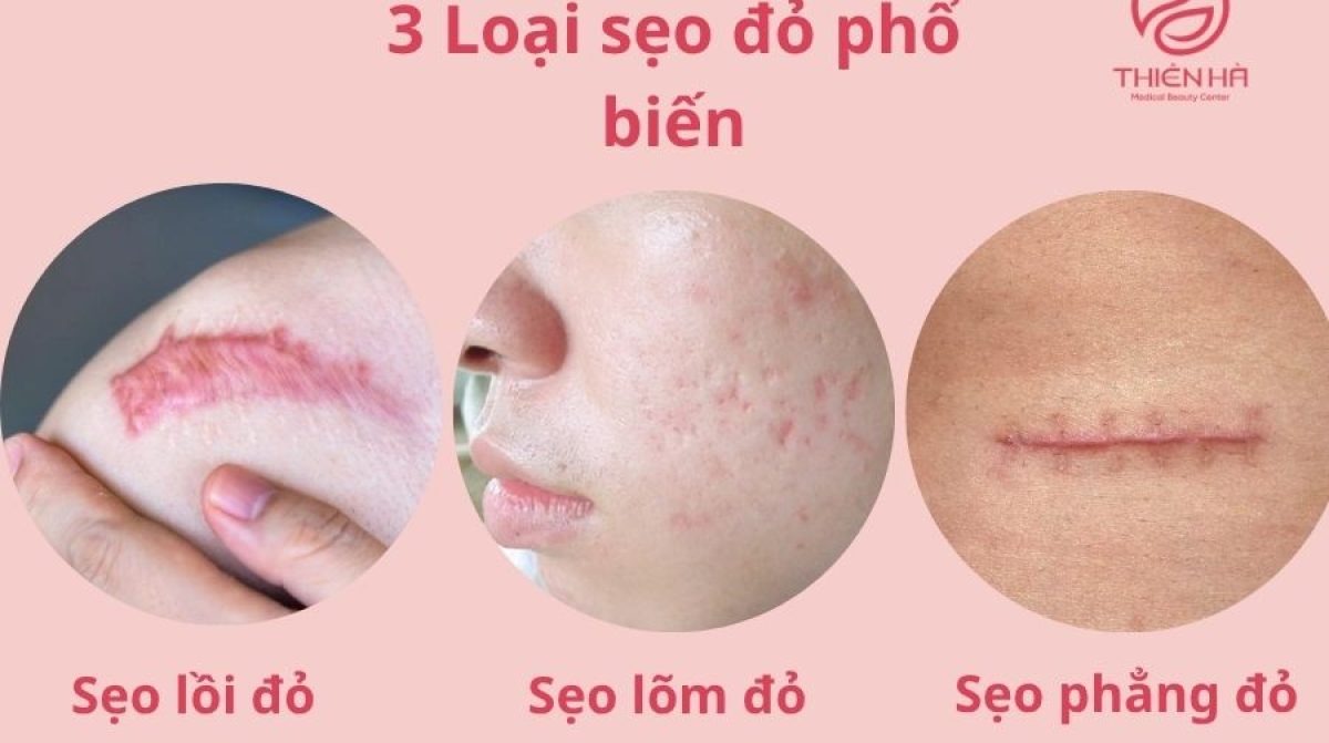 Sẹo đỏ bao lâu thì hết? Nguyên nhân và cách điều trị hiệu quả