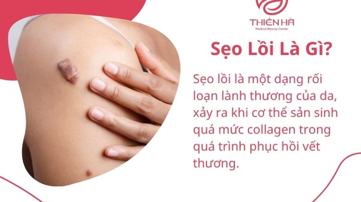 Sẹo Lồi Là Gì? Nguyên Nhân, Dấu Hiệu & Cách Điều Trị Hiệu Quả