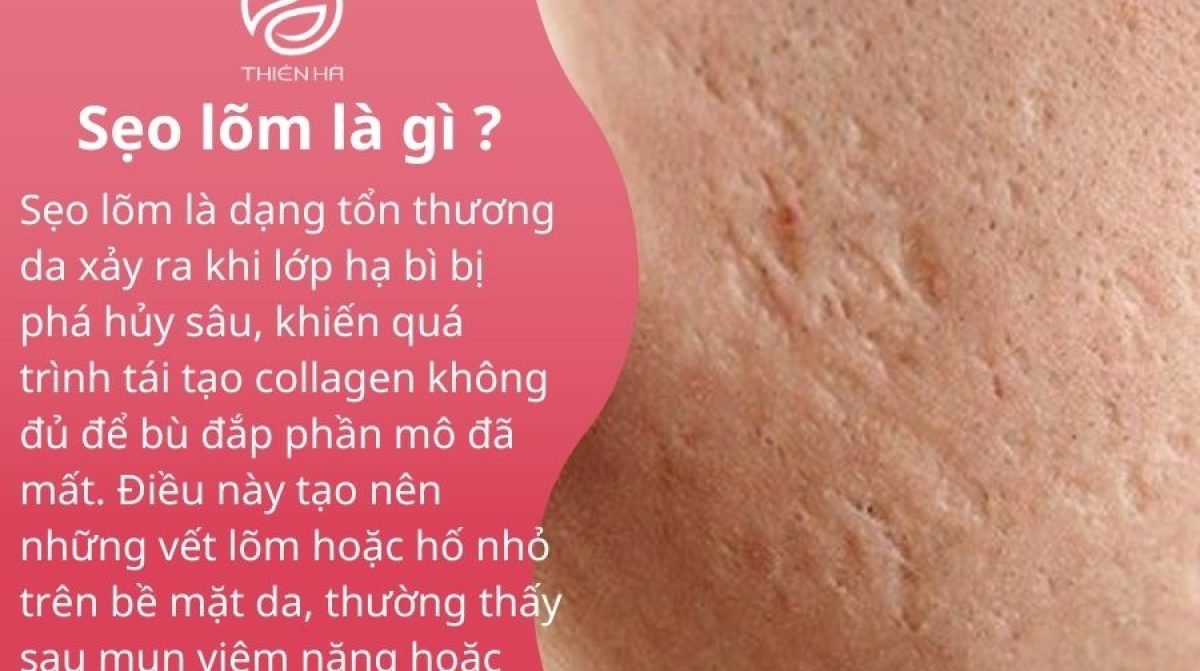 Sẹo lõm: Nguyên nhân, cách điều trị hiệu quả và chi phí cụ thể