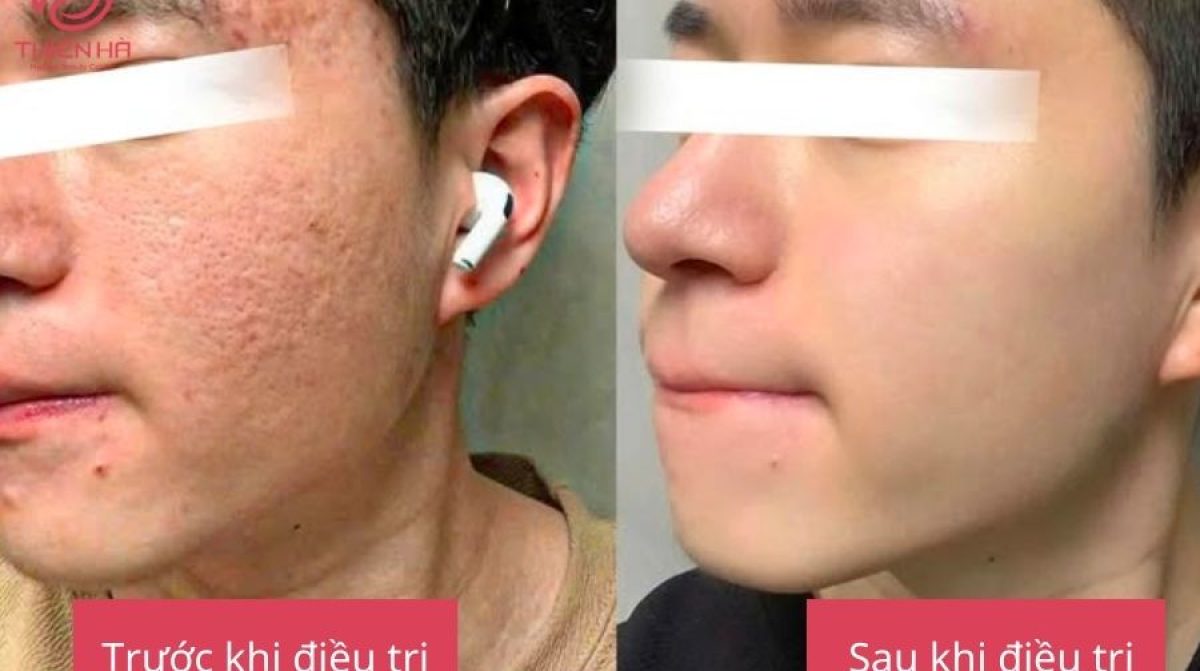 Sẹo lõm lâu năm có trị được không? Quy trình điều trị tại Thiên Hà