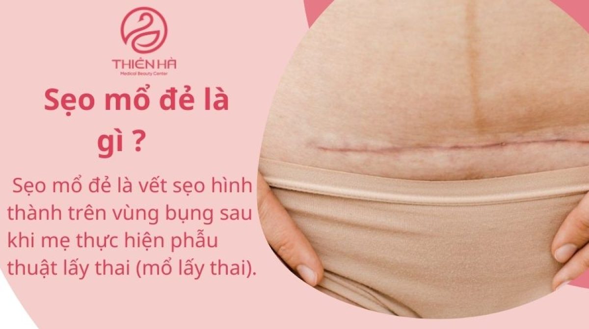 Sẹo mổ đẻ: Nguyên nhân, chăm sóc và cách điều trị thẩm mỹ sau sinh