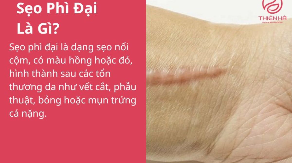 Sẹo Phì Đại Là Gì? Nguyên Nhân, Triệu Chứng Và Cách Điều Trị Hiệu Quả