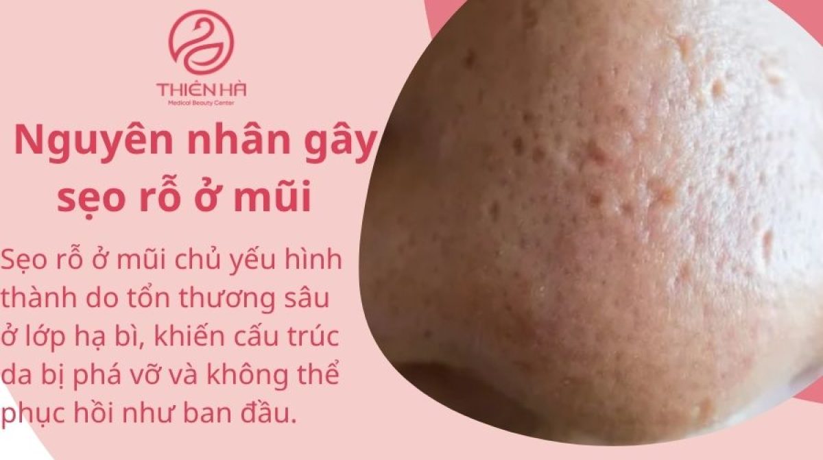 Trị sẹo rỗ ở mũi hiệu quả: Nguyên nhân, cách điều trị và chăm sóc