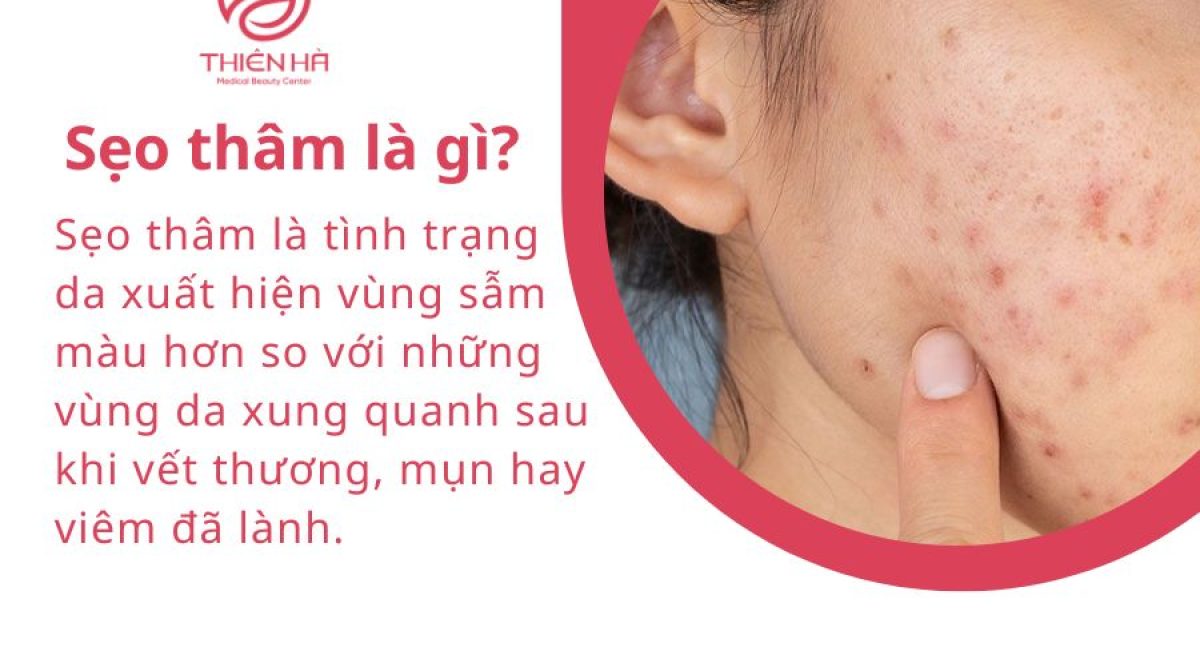 Sẹo thâm : Cách trị tại nhà và công nghệ y khoa an toàn hiệu quả