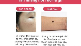 Sự khác nhau giữa nốt ruồi và tàn nhang: Cách nhận biết chính xác