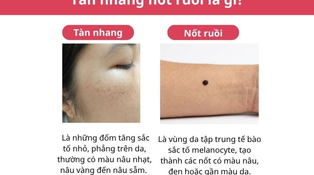 Sự khác nhau giữa nốt ruồi và tàn nhang: Cách nhận biết chính xác