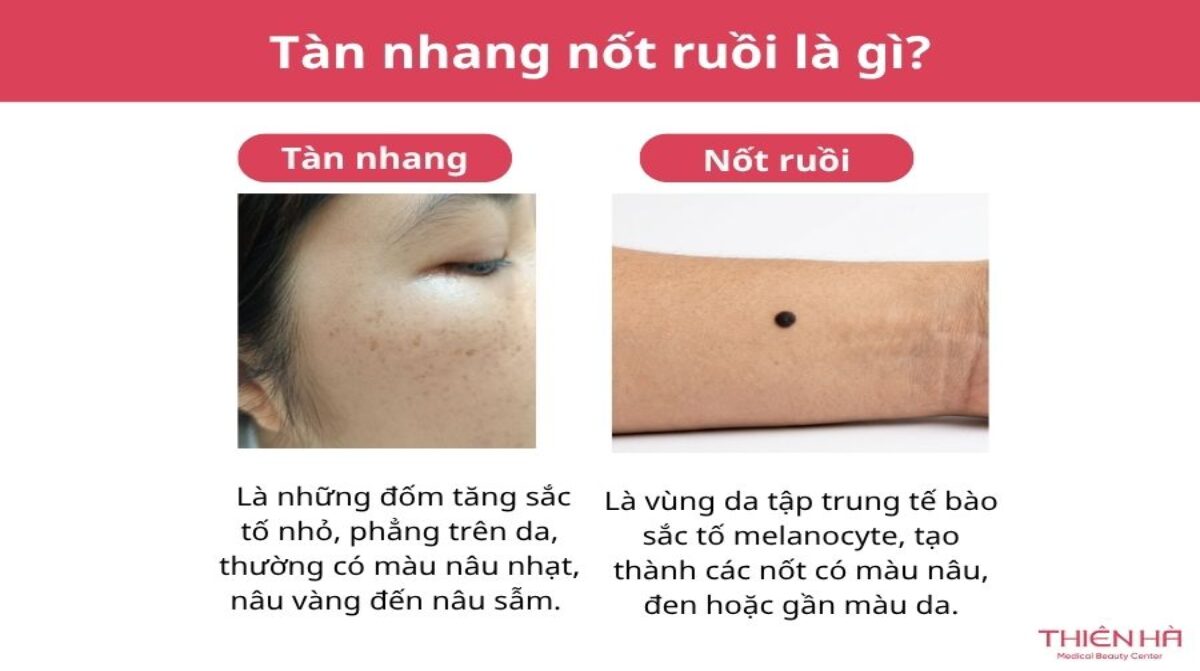Sự khác nhau giữa nốt ruồi và tàn nhang: Cách nhận biết chính xác