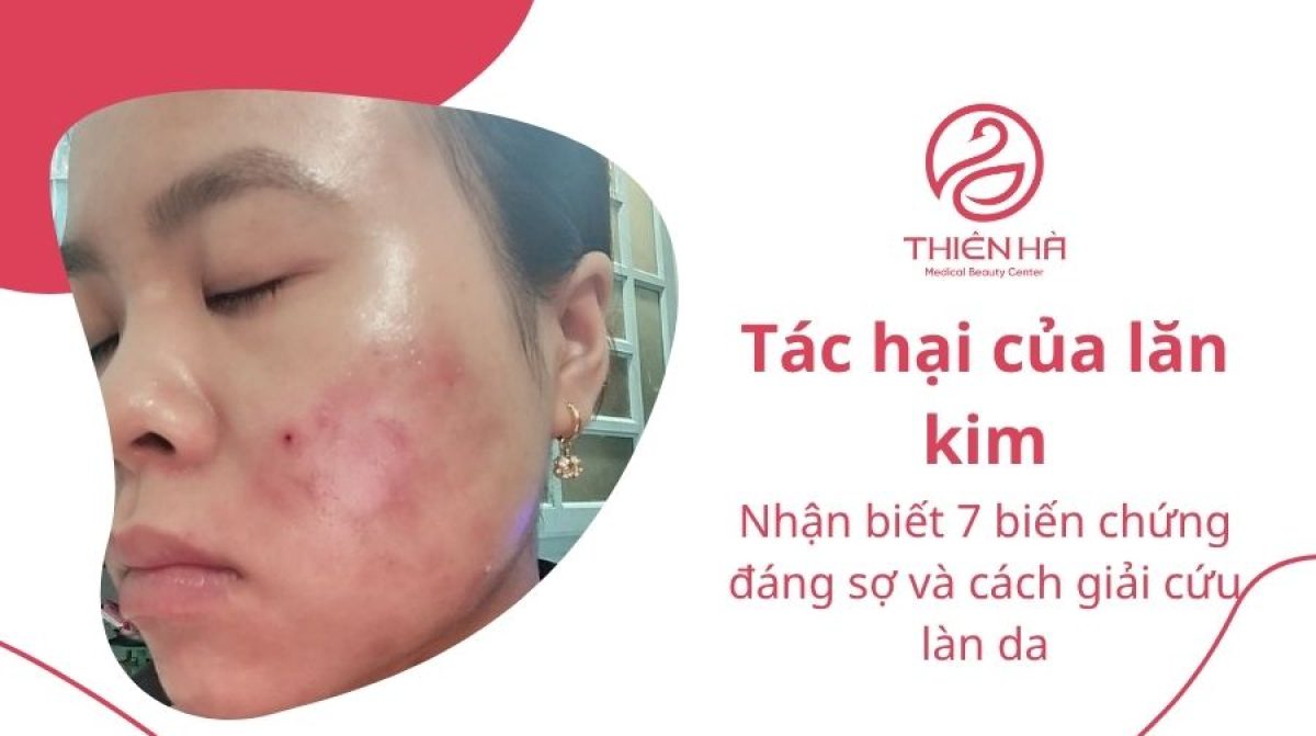 Tác hại của lăn kim: 7 biến chứng đáng sợ và cách giải cứu làn da