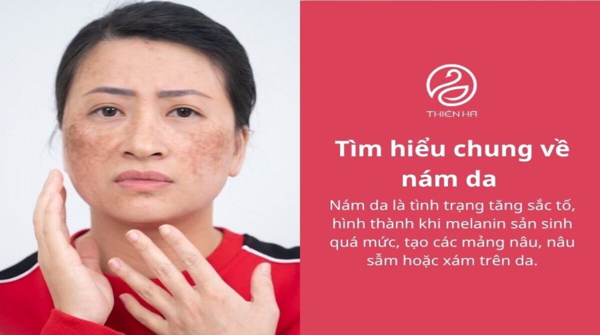 Tác hại của nám da: 5 ảnh hưởng nghiêm trọng cần biết