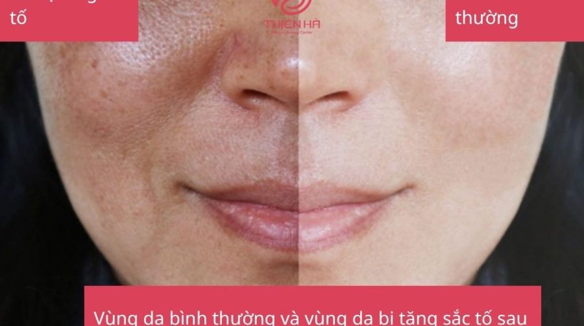 Tác hại của laser CO2: Những điều cần biết trước khi điều trị