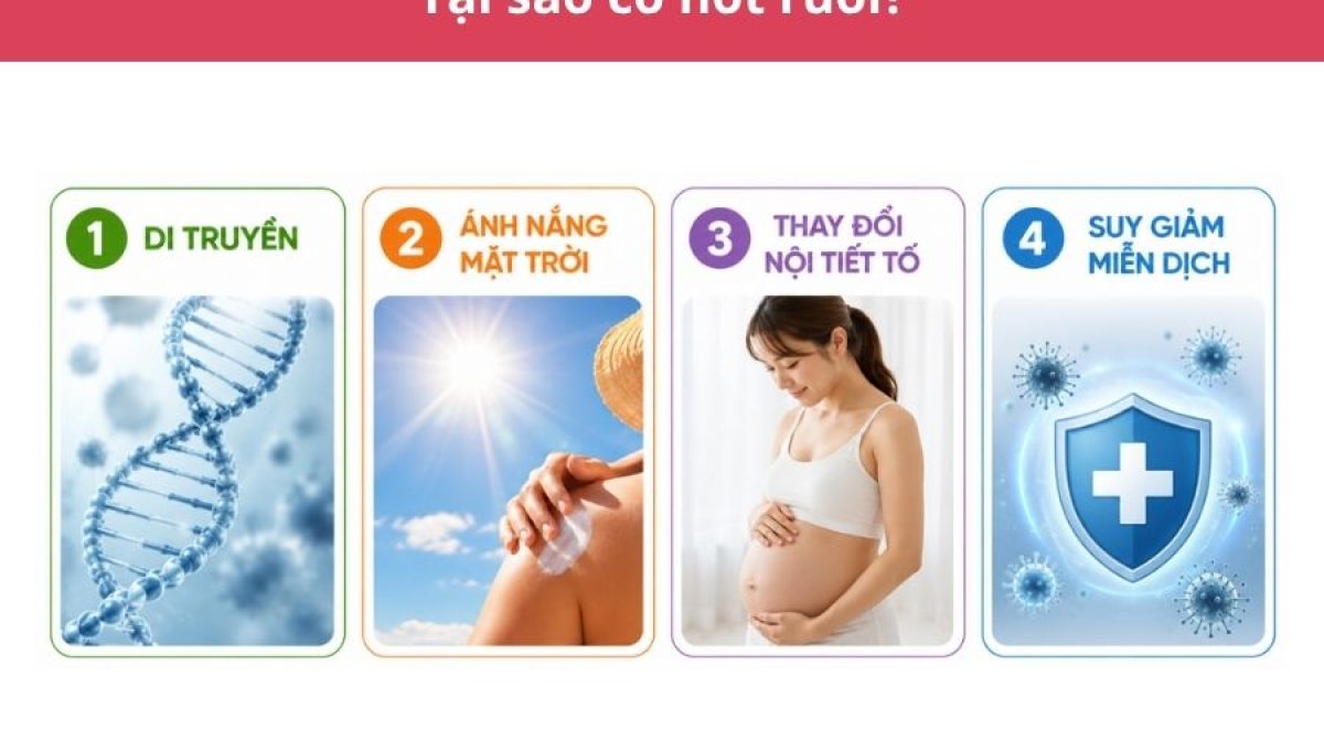 Tại sao lại có nốt ruồi? Nguyên nhân và cách nhận biết