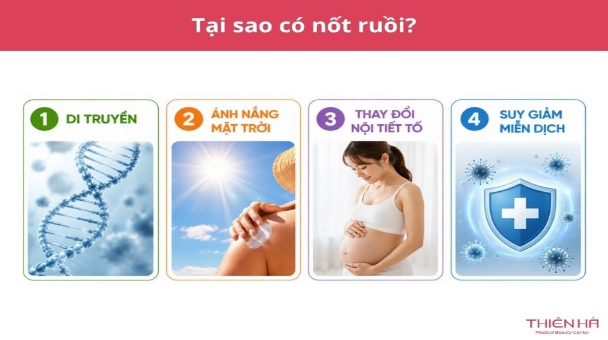 Tại sao lại có nốt ruồi? Nguyên nhân và cách nhận biết