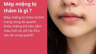 Tại sao mép miệng bị thâm? Nguyên nhân và cách khắc phục hiệu quả