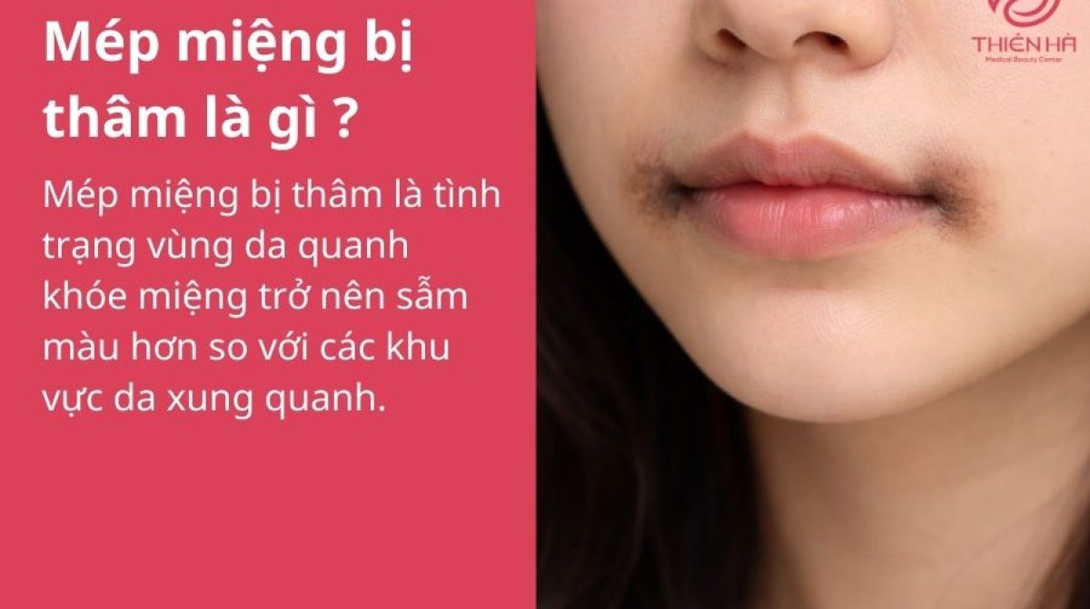 Tại sao mép miệng bị thâm? Nguyên nhân và cách khắc phục hiệu quả