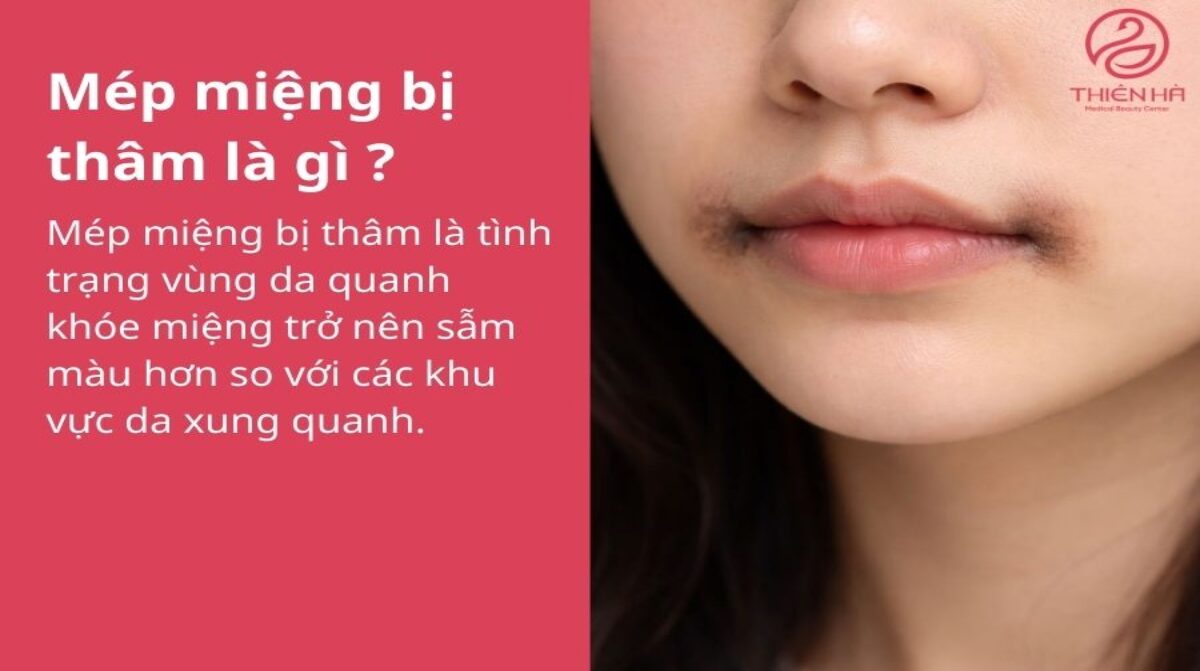 Tại sao mép miệng bị thâm? Nguyên nhân và cách khắc phục hiệu quả