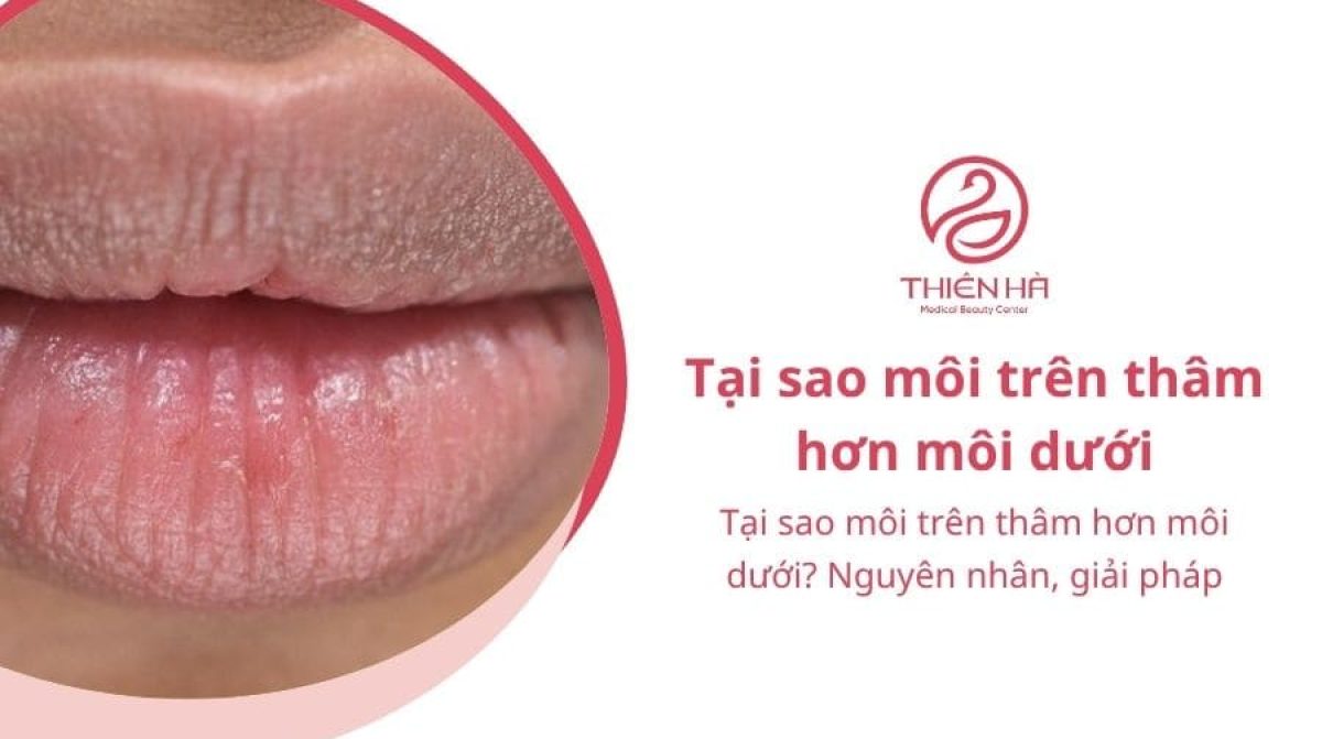 Tại sao môi trên thâm hơn môi dưới? Nguyên nhân, giải pháp