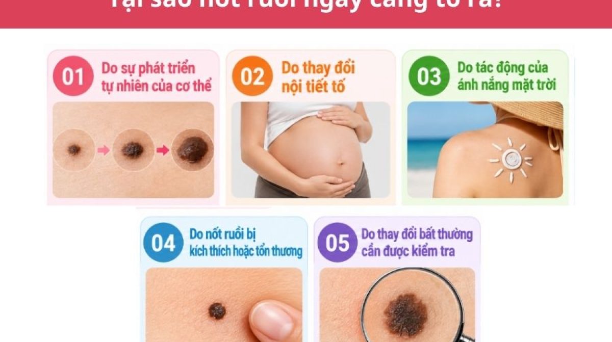 Tại sao nốt ruồi ngày càng to ra? Có nguy hiểm không? Xem ngay