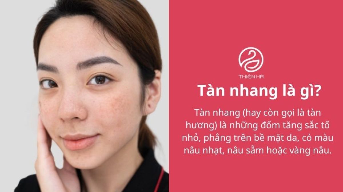 Tàn nhang là gì? Nguyên nhân và cách điều trị hiệu quả
