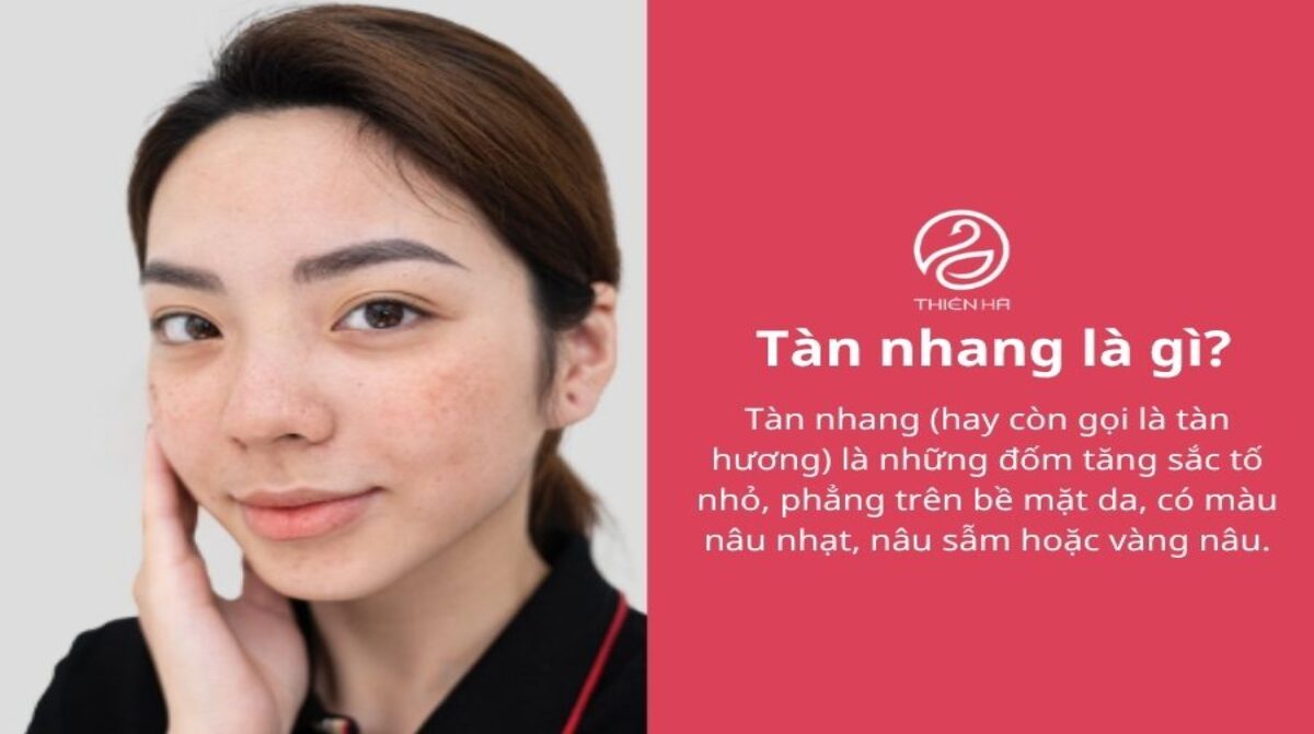 Tàn nhang là gì? Nguyên nhân và cách điều trị hiệu quả