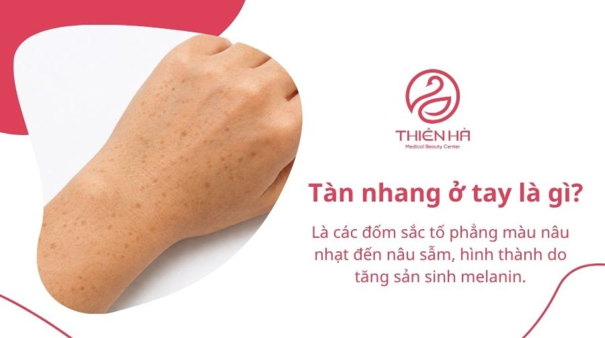 Tàn nhang ở tay là gì? Nguyên nhân và cách xử lý hiệu quả