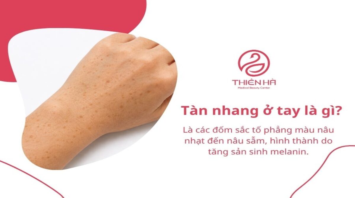 Tàn nhang ở tay là gì? Nguyên nhân và cách xử lý hiệu quả