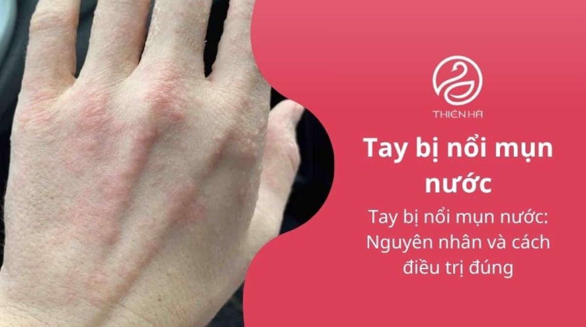 Tay bị nổi mụn nước: Nguyên nhân và cách điều trị đúng