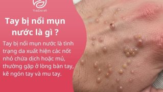 Tất tần tật về tay bị nổi mụn nước : Nguyên nhân và cách xử lý
