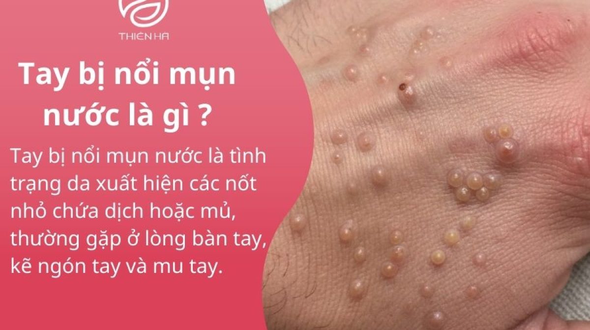 Tất tần tật về tay bị nổi mụn nước : Nguyên nhân và cách xử lý