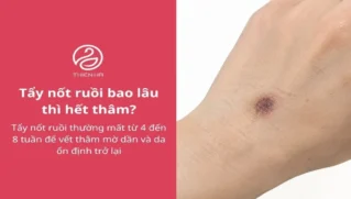 Tẩy nốt ruồi bao lâu thì hết thâm? Bí quyết giúp da đều màu hơn