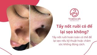 Tẩy nốt ruồi có để lại sẹo không? Nguyên nhân và cách hạn chế
