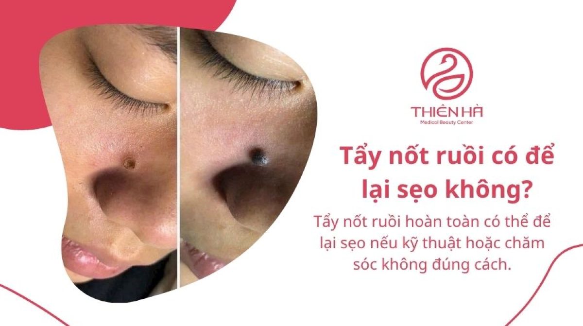 Tẩy nốt ruồi có để lại sẹo không? Nguyên nhân và cách hạn chế