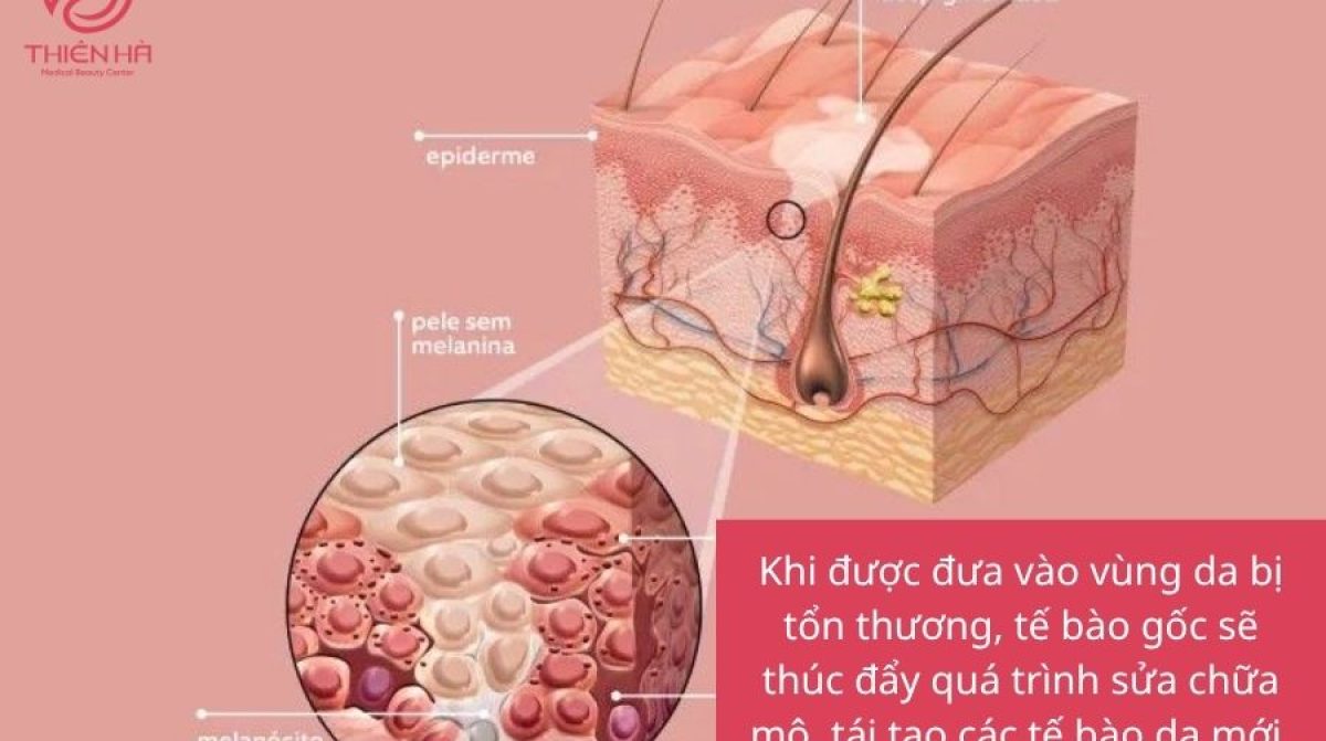 Trị Sẹo Rỗ Bằng Tế Bào Gốc: Hiệu Quả, An Toàn và Quy Trình Thực Hiện
