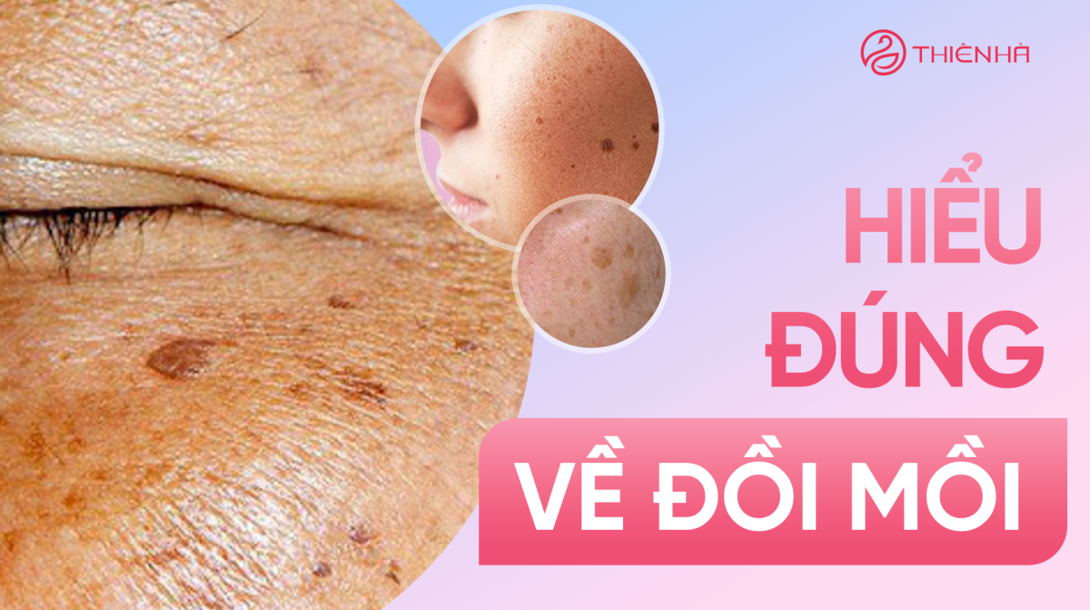 Hiểu đúng về đồi mồi và cách chăm sóc da đúng cách