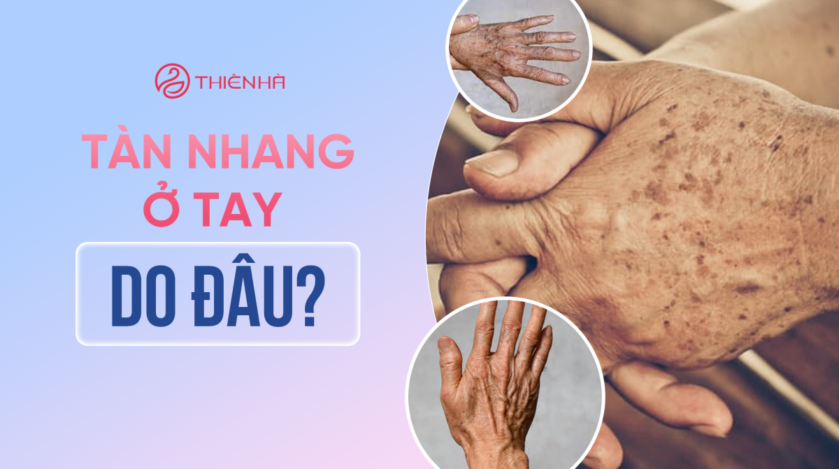 Tàn nhang ở tay do đâu? Cách trị tận gốc