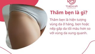 Thâm bẹn: Nguyên nhân và cách trị hiệu quả, an toàn