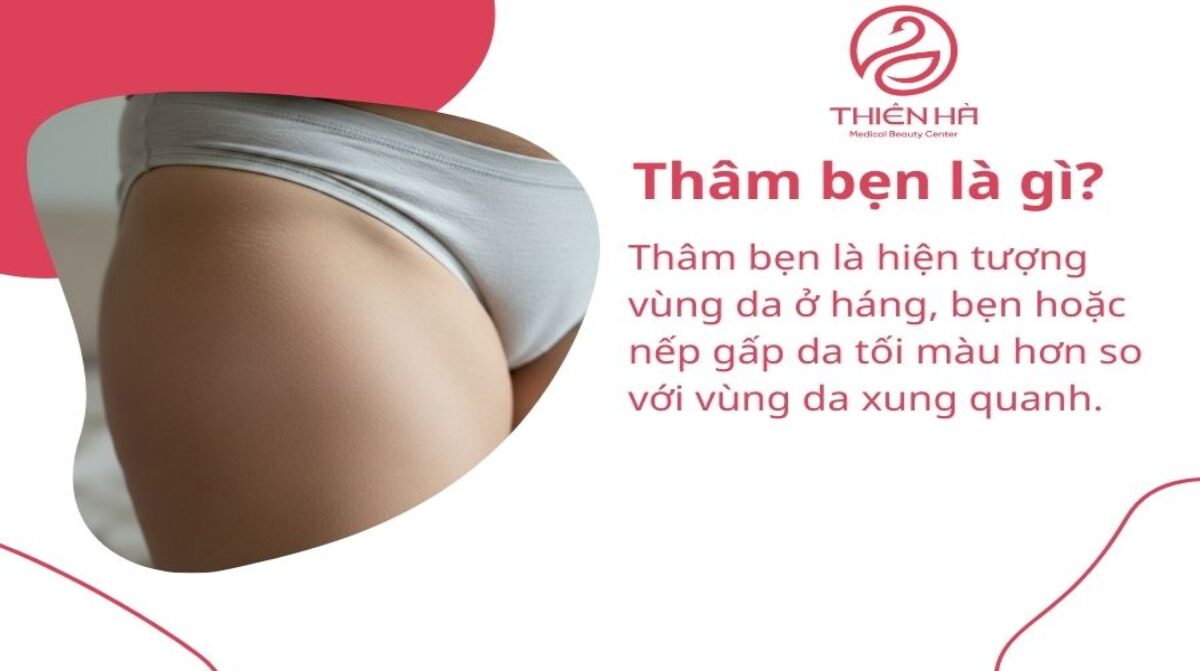 Thâm bẹn: Nguyên nhân và cách trị hiệu quả, an toàn