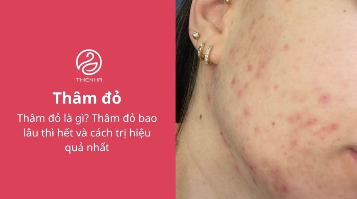 Thâm đỏ là gì? Thâm đỏ bao lâu thì hết và cách trị hiệu quả nhất