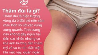 Thâm đùi là gì? Nguyên nhân phổ biến và cách trị thâm đùi hiệu quả