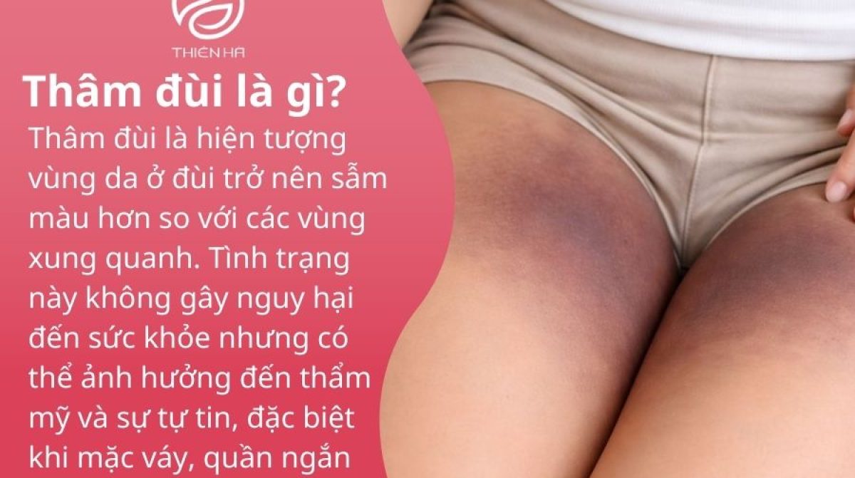 Thâm đùi là gì? Nguyên nhân phổ biến và cách trị thâm đùi hiệu quả