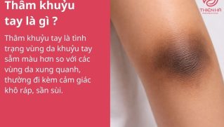 Thâm khuỷu tay: Nguyên nhân và cách khắc phục hiệu quả, an toàn