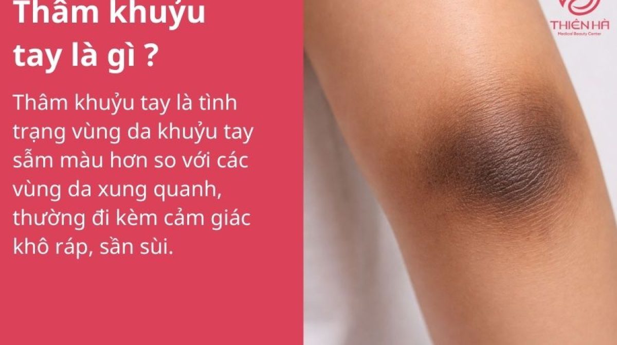 Thâm khuỷu tay: Nguyên nhân và cách khắc phục hiệu quả, an toàn